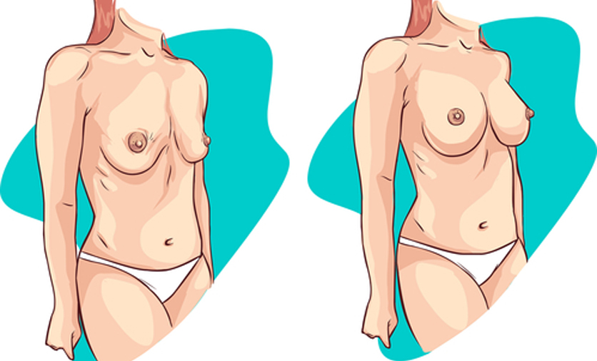 Saggy Boobs After Weight Loss - What can I do? Ask the Expert