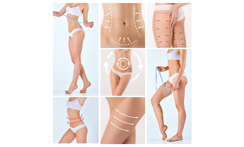 liposuction