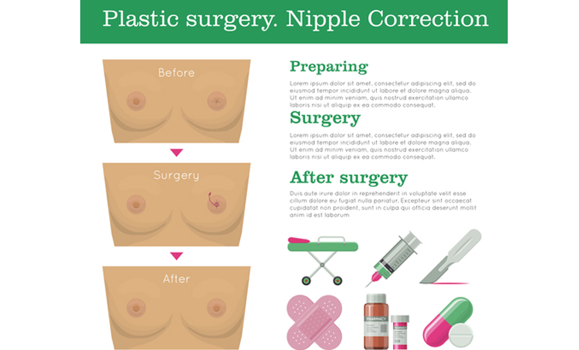 inverted nipple surgery