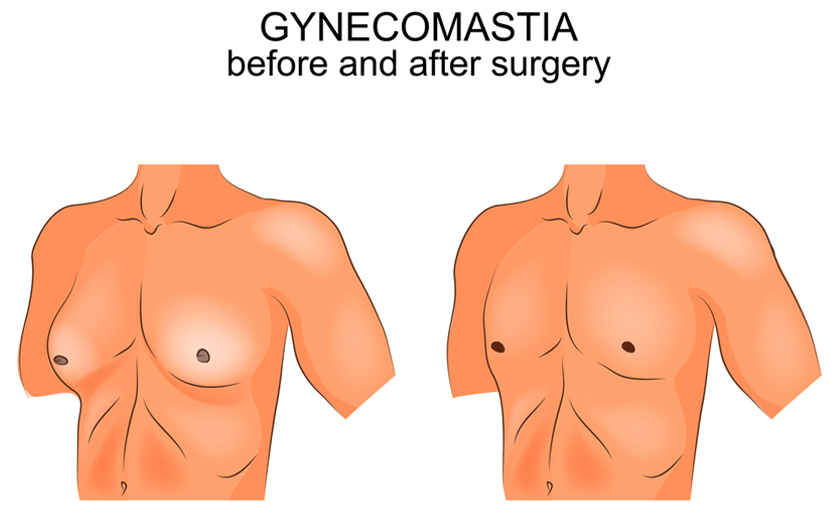 gynecomastia surgery